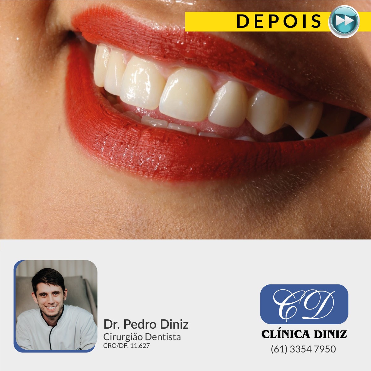 Pedro-gengivoplastia(depois)